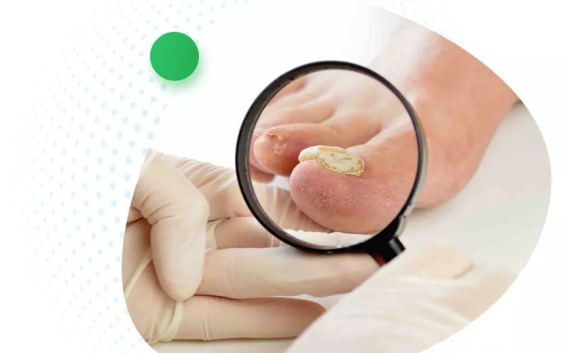What is The Fastest Way to Cure Toenail Fungus?